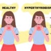 Stress & Thyroid: What's the Connection?