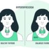 Underactive Thyroid: What is Hypothyroidism?