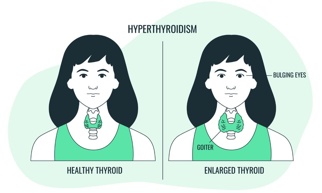 Underactive Thyroid: What is Hypothyroidism?