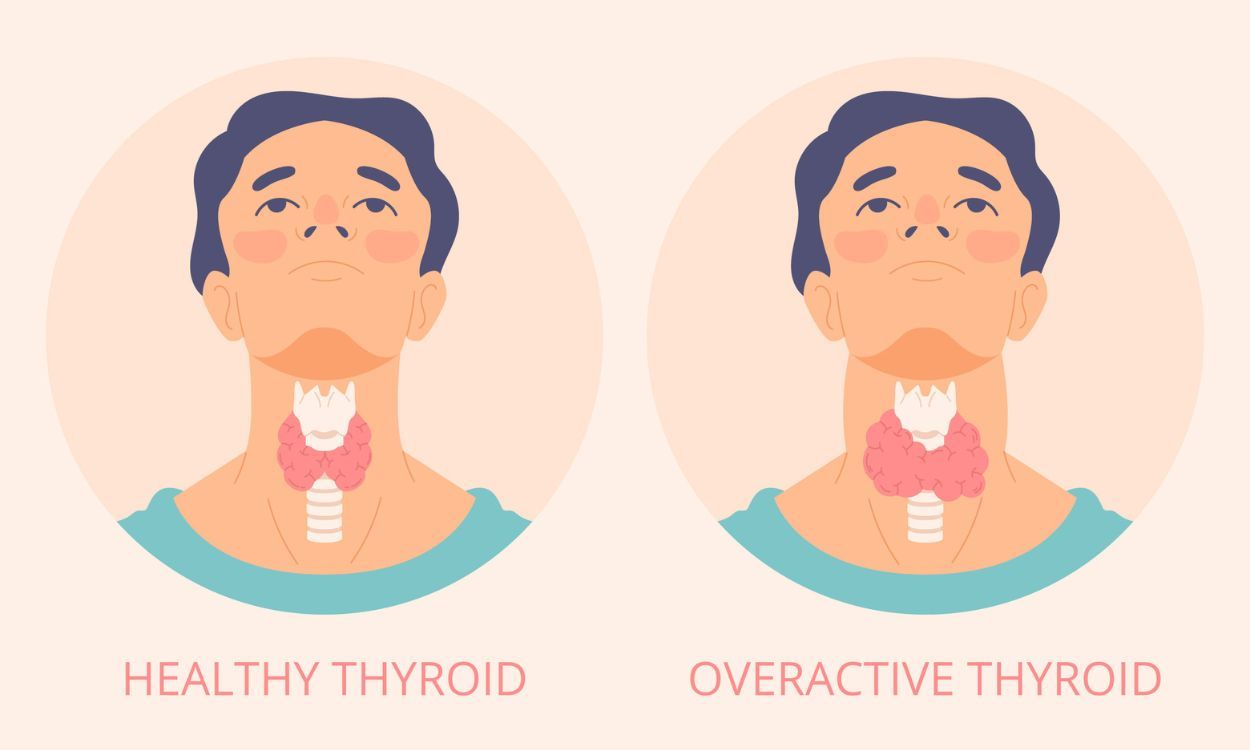 Iodine intake for optimal thyroid health