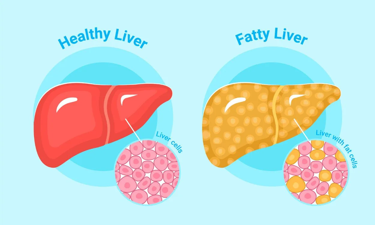 What is fatty liver? - FITPAA