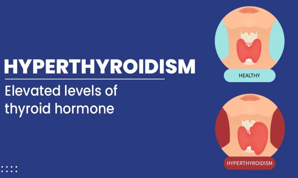 How Is Hyperthyroidism Diagnosed Fitpaa 5070