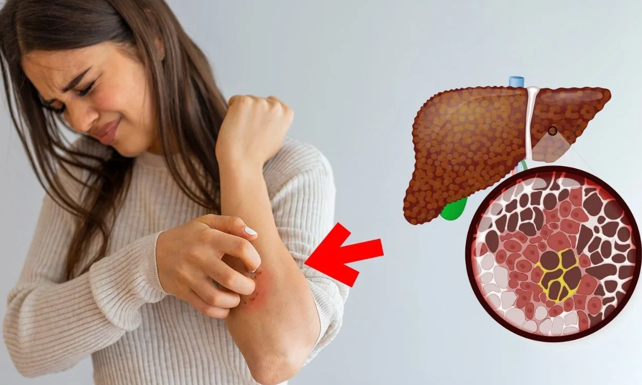 Can Fatty Liver Cause Skin Problems Fitpaa 